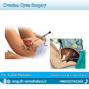 Ovarian Cysts Removal using Laparoscopy